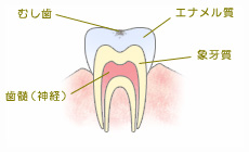 C0.エナメル質の表面が少し溶けた状態