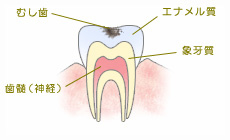 C1.エナメル質に小さな穴が開いた状態