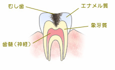 C2.象牙質まで虫歯が進行した状態