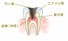 歯髄（神経）まで虫歯に侵された状態