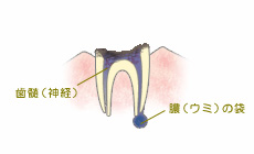歯髄が無くなり、歯根だけになった状態