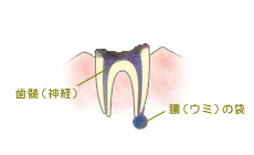 C4.歯髄が無くなり、歯根だけになった状態